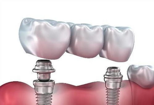 影响种植牙耐用性的因素