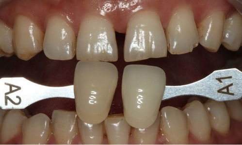 如何减少磨牙对牙齿的影响