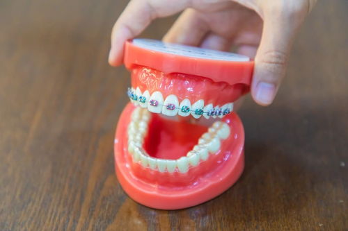 牙龈萎缩与牙齿矫正