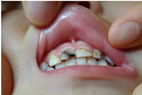 儿童龋齿的早期症状
