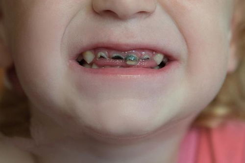 儿童龋齿是否需要补牙