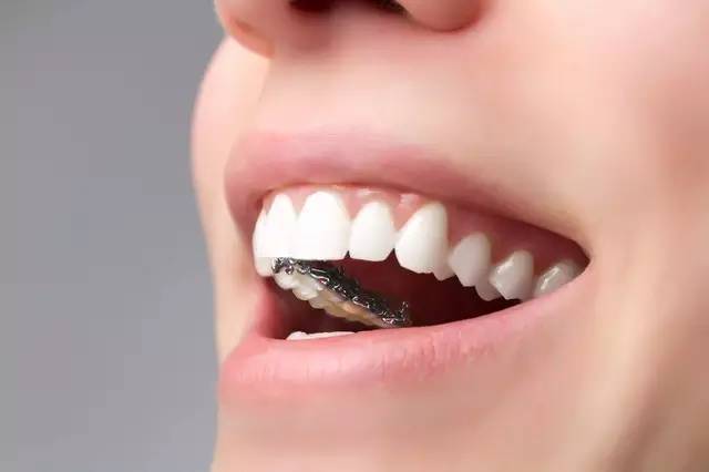 牙齿矫正出现黑三角的原因