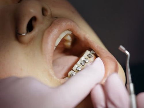矫正过程中牙齿酸痛的原因