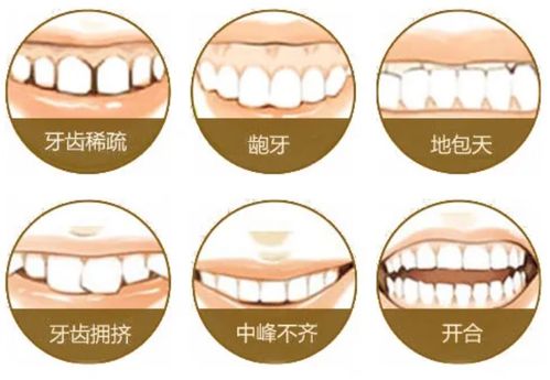 牙颌畸形的常见类型及表现