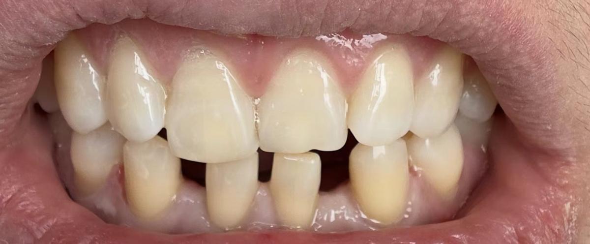 牙齿稀疏缝隙大的矫正方法