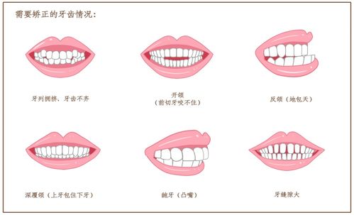 常见的牙颌畸形类型