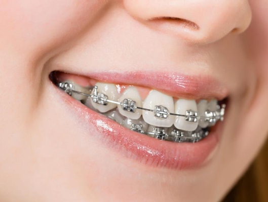 成年人牙齿矫正可能存在的隐患