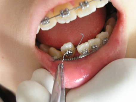 快速矫正牙齿的潜在风险