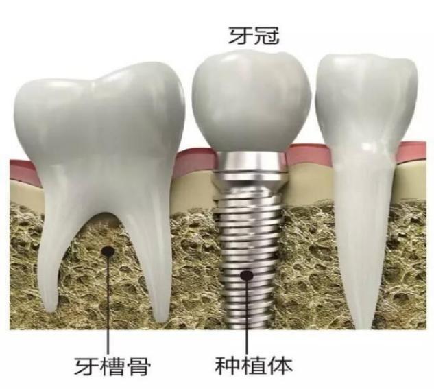 种牙时牙龈发炎的原因及应对措施