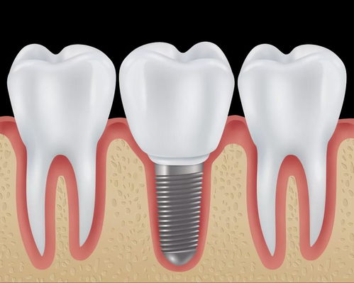 种植牙齿失败的表现及原因
