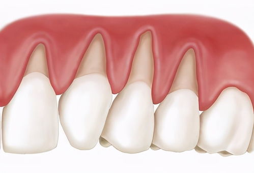 牙龈及牙周组织相关并发症
