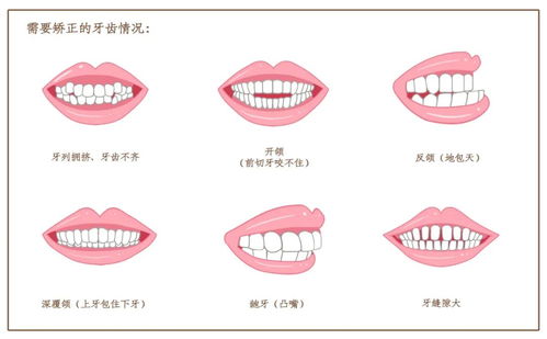 错颌畸形的类型