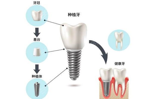 天然牙与种植牙的区别