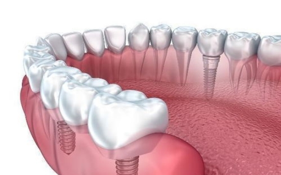 了解种植牙的材料特性
