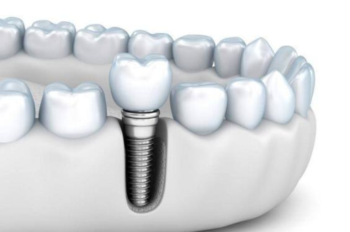 种植牙贵的原因