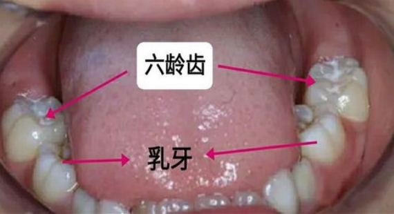 不同程度“六龄齿”龋齿的治疗方法