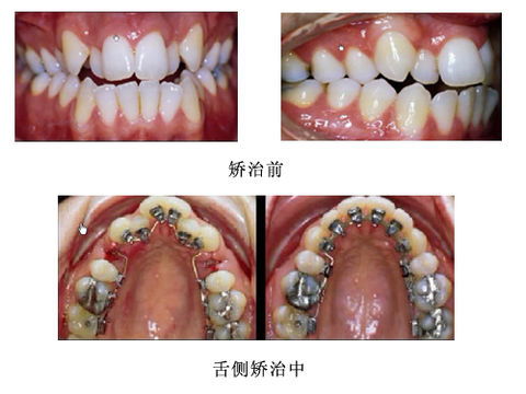 舌侧矫正后的口腔清洁方法