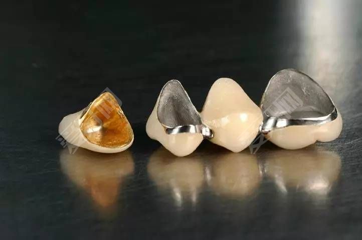 缺牙适合哪种材料假牙