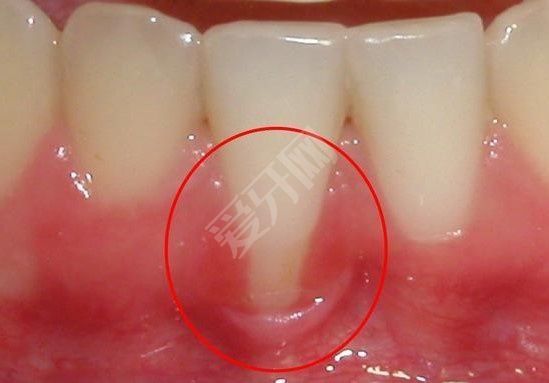 牙龈萎缩能做植牙吗
