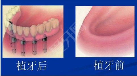 宝威体育官网：拜博口腔0元种牙：技术免费牙收费 广告宣传违规