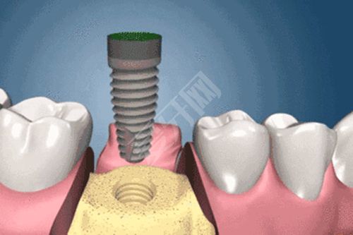 植入种植体后多长时间安装基台 植牙前后得多久