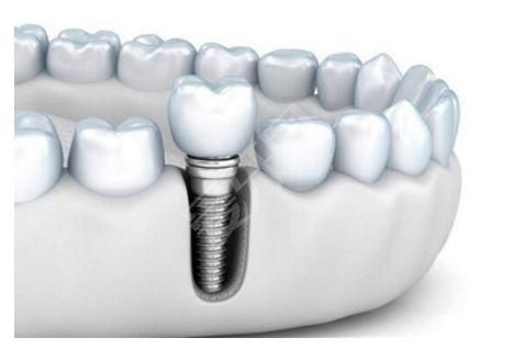 植牙需要去几次医院