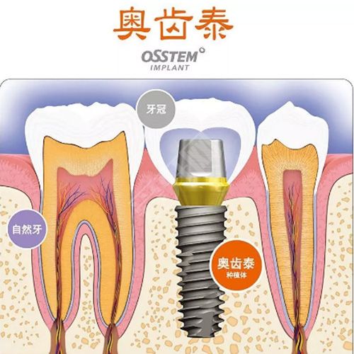 种植系统韩国奥齿泰有哪些特点 一颗得花多少钱