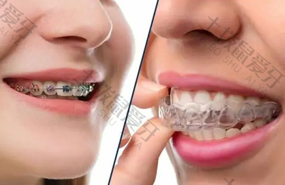 隐形牙套vs钢丝牙套