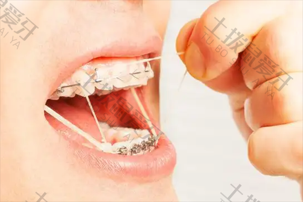 牙齿矫正有哪几种方法