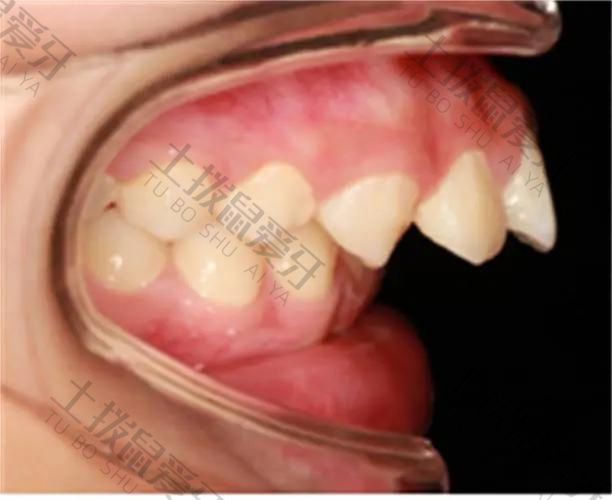 牙齿矫正过程中会出现咬合问题吗