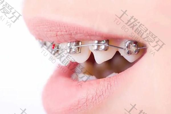 牙齿矫正过程中一般换几次钢丝