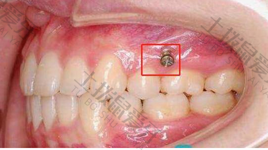 矫正牙齿拥挤需要打骨钉