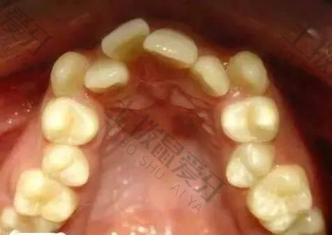 骨性牙齿矫正有效果吗