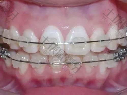 牙齿矫正戴牙套需要多长时间