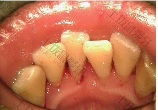 矫正牙齿牙龈萎缩正常吗