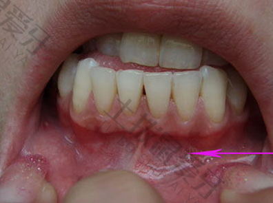 矫正牙齿牙龈萎缩可以恢复吗