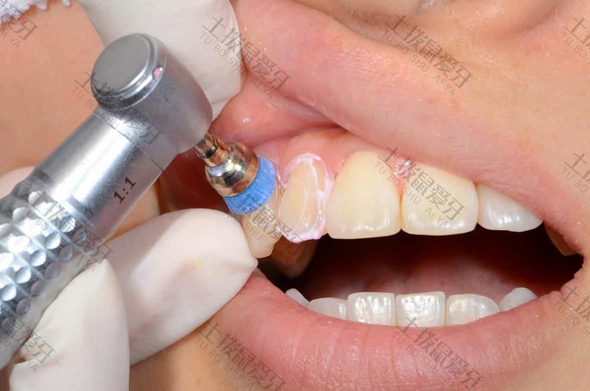 口腔医院牙种植牙多少钱一颗