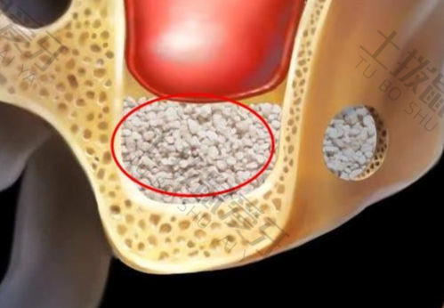 种植牙植骨骨粉价格