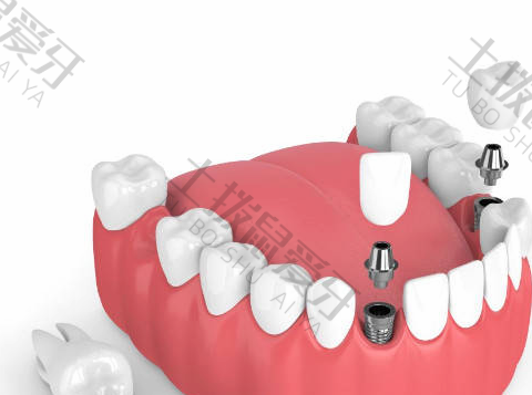种植牙后肿几天
