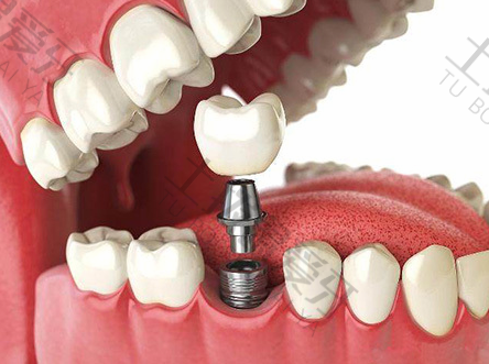 种植牙后牙龈萎缩现象很普遍吗