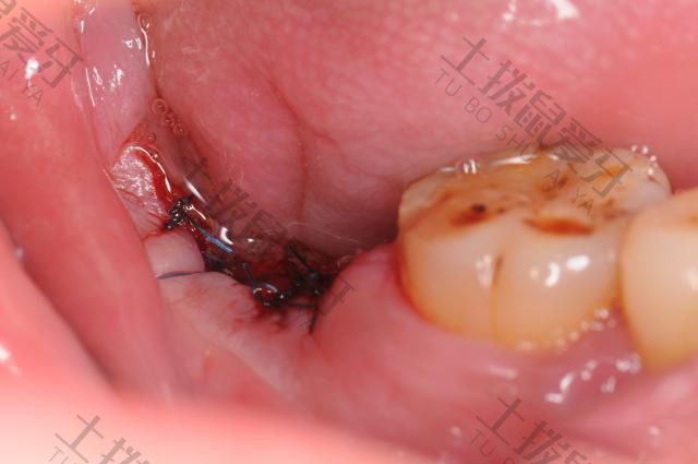 种植牙后牙龈肿胀正常吗