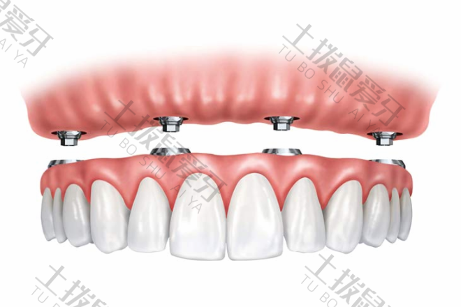满口种植牙需要几个桩