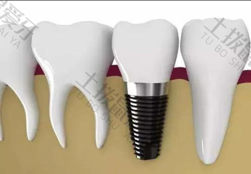 完整的牙根种植牙过程
