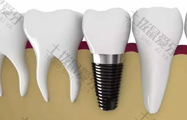 完整的牙根种植牙过程