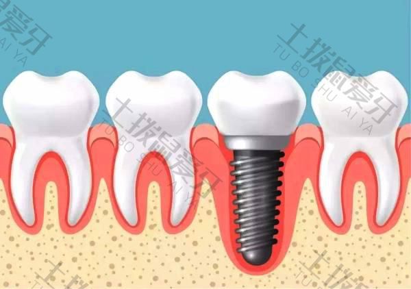 种植牙的材料及价格