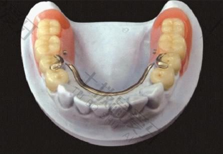 种植牙手术需要多长时间完成