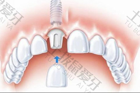 种植牙的材料及价格