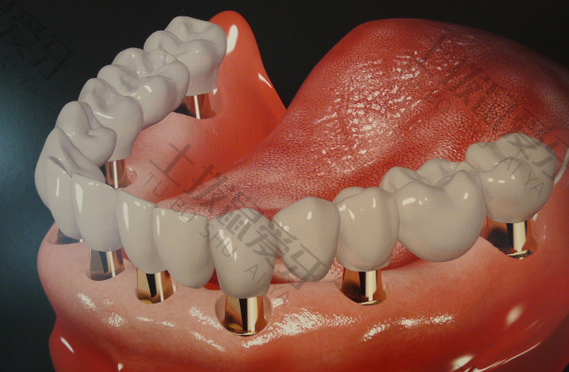 种植牙二期手术过程