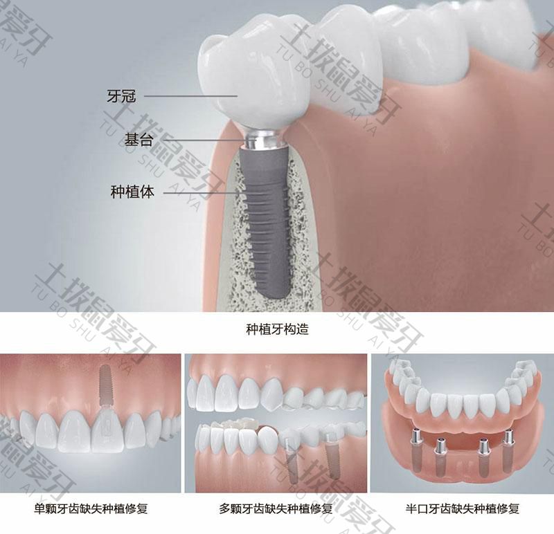种植牙费用怎么算