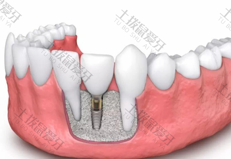 种植牙对牙槽骨的危害大吗
